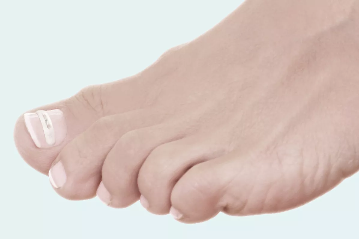 Nagelkorrektur mit Klebespange — Spangentechnik Fußpflege